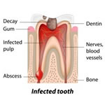 root canal treatment