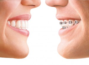 invisalign product photo 1